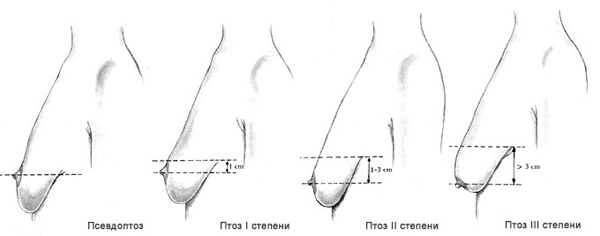 Маммопластика мастопексия (подтяжка)